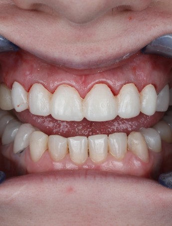 Reconstructie Completa cu Implanturi All-on-4