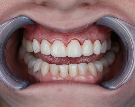 Reconstructie Completa cu Implanturi All-on-4