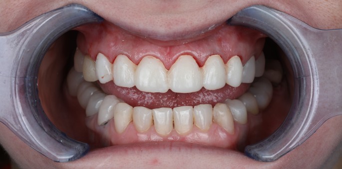 Reconstructie Completa cu Implanturi All-on-4