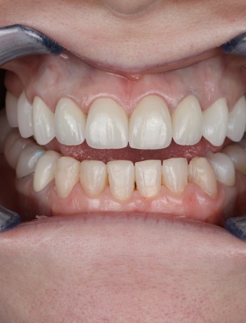 Makeover Estetic Complet cu Facete de Portelan