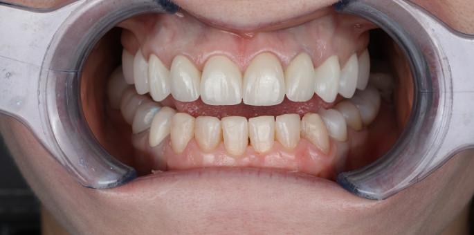 Makeover Estetic Complet cu Facete de Portelan