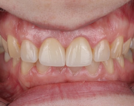 Tratament Complex de Parodontologie si Regenerare