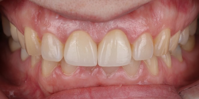 Tratament Complex de Parodontologie si Regenerare