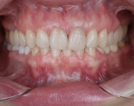 Coroane Ceramice Integral pentru Zona Estetica