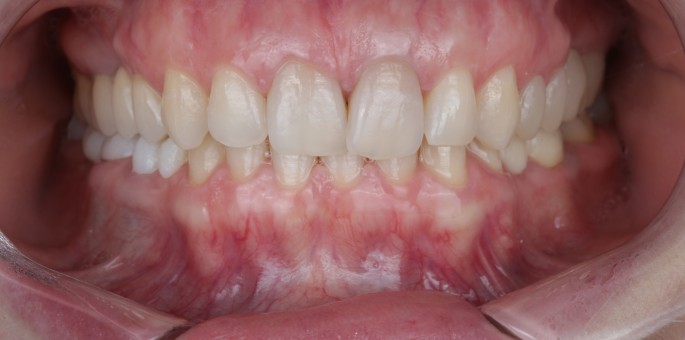 Coroane Ceramice Integral pentru Zona Estetica